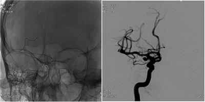 Novel in vivo Assessment of Unruptured Intracranial Aneurysm Inflammatory Factors